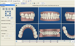 invisible braces computer modelling